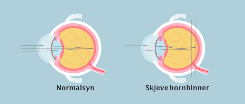 Illustrasjonsbilde som viser skjeve hornhinner