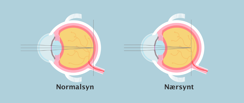Illustrasjon som viser forskjell på øye med normalt syn og nærsynt
